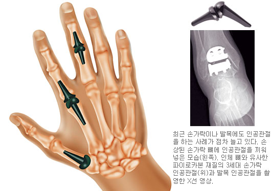 인공관절의 진화… 손가락 기능 회복도 OK