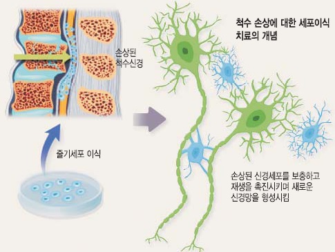 ‘신경줄기세포’ 척수손상 치료 마중물 될까… 세브란스병원, 임상 환자 모집 기사의 사진