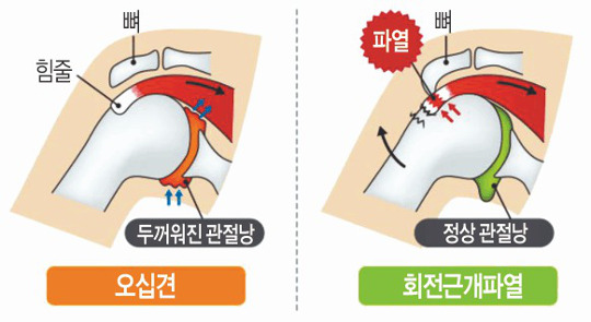 [And 건강] 몸짱 되려 무리했더니… 어깨 질환 200만명 시대 기사의 사진