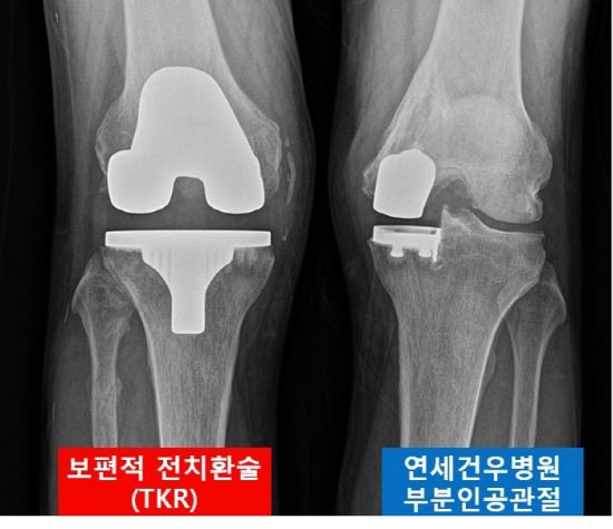 부분무릎인공관절 도입 심리·경제 부담 낮췄다 국민일보 