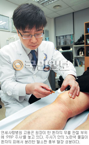 초기 관절염·연골 손상 PRP주사로 수술 없이 치료  