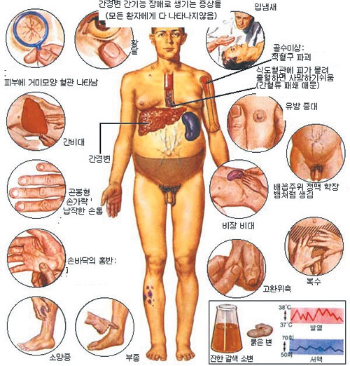 간염 대부분은 바이러스 감염이 원인  