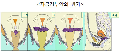 [암 이렇게 극복하자(6)-자궁경부암] ①자궁경부암은 왜 생기는 것일까?  
