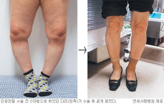 “인공관절 무료 수술 받고 고통 벗어나세요”  