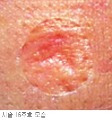 “자신의 피부세포 이용 여드름 흉터 말끔히 치료”  