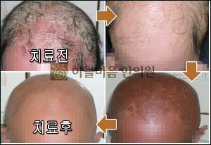 늘어나는 탈모, 지루성피부염 원인이라면 면역력 살펴야  