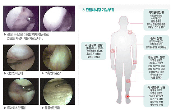 30대 여성 무릎 유리체 제거술 관절경 활막액 물청소 부산성모병원 입원 부산무릎잘하는곳 부산성형외과추천 2