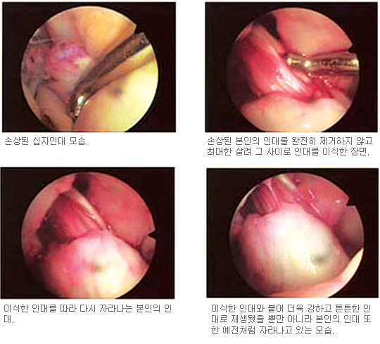 무릎 십자인대파열, 봉합-재건 수술할때 관건은 자기 인대 최대한 살리는 것  