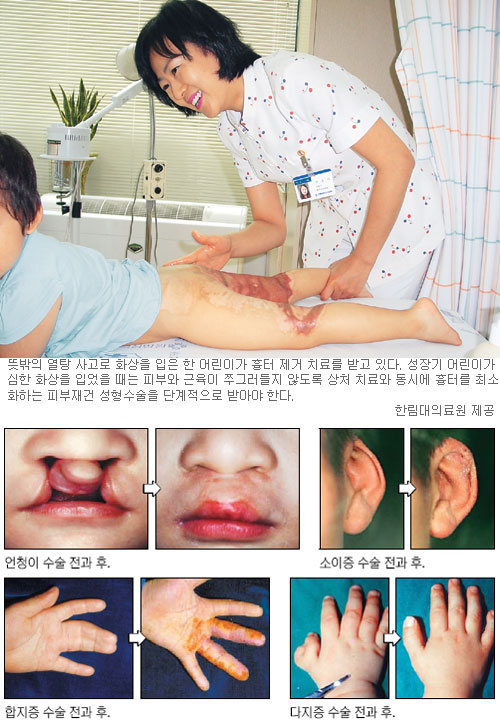 기형 재건성형수술, 어리다고 미루지말라  