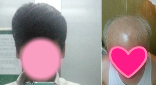 “너무 무섭고 끔찍, 차라리 조작이기를”…피부과 탈모 치료 후 머리카락이 ‘충격’  
