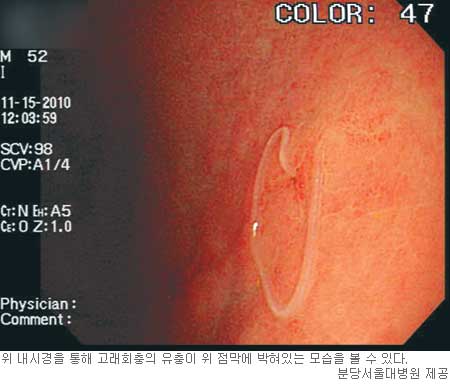 바다생선에 '고래회충' 우글우글...위 장벽 뚫어 4~6시간후 콕콕 찌르는 윗배 통증,구토, 위경련 일으켜  