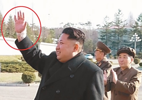 [포토] 김정은 손목 부상  