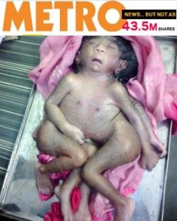 헉！인도에서 또 팔·다리 8개 아기 출생…‘신의 재림?’ 기사의 사진