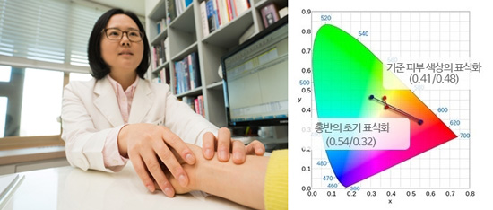 건선의 이상징후, 피부에만 나타나지 않는다.  