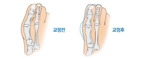  ܹ ȯ 10% ٳణ ǿ캴 ܹ ŬС  
