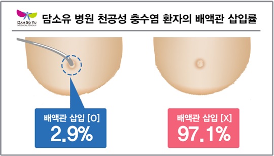 담소유병원 “맹장수술에 대한 익숙한 진실과 이별 하세요”  