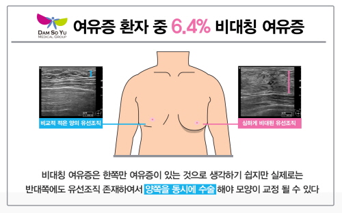 담소유병원 임상 연구 결과, ‘비대칭여유증’ 재수술 위험 높일 수 있어  