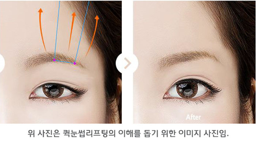절개없는 간편한 눈썹거상술 퀵눈썹리프팅  