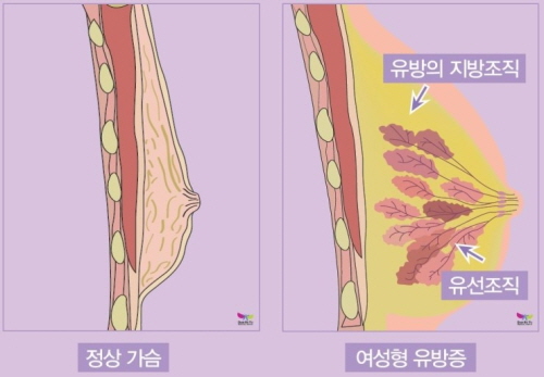 여유증 재발 방지 위해 수술 전 고려해야 할 사항은…  