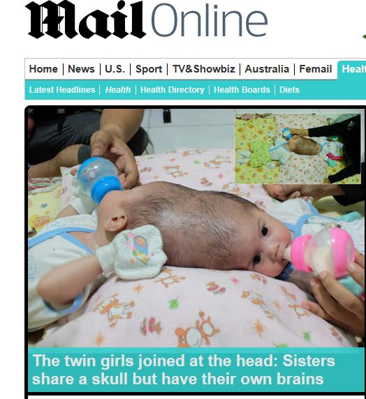 머리가 일자로 붙은 샴쌍둥이 자매, 분리 수술 가능할까  
