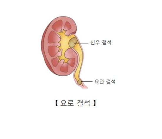 8월의 불청객 '요로 결석'…맥주 마시면 돌이 빠진다고?-국민일보